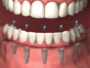 Dentures over implant image