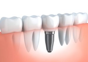 dental implant image